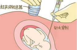 脐带血穿刺,生命之源的采集与未来医疗的无限可能